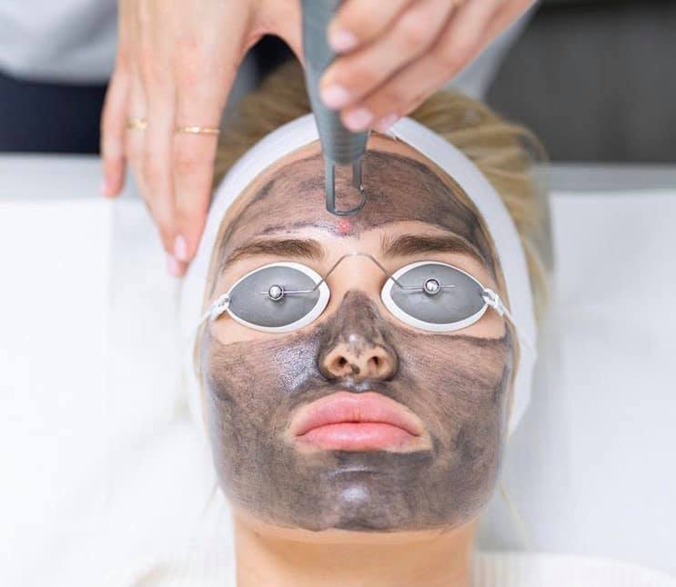 Carbon-Laser-Peel-Treatment-Koha-Berkhamsted